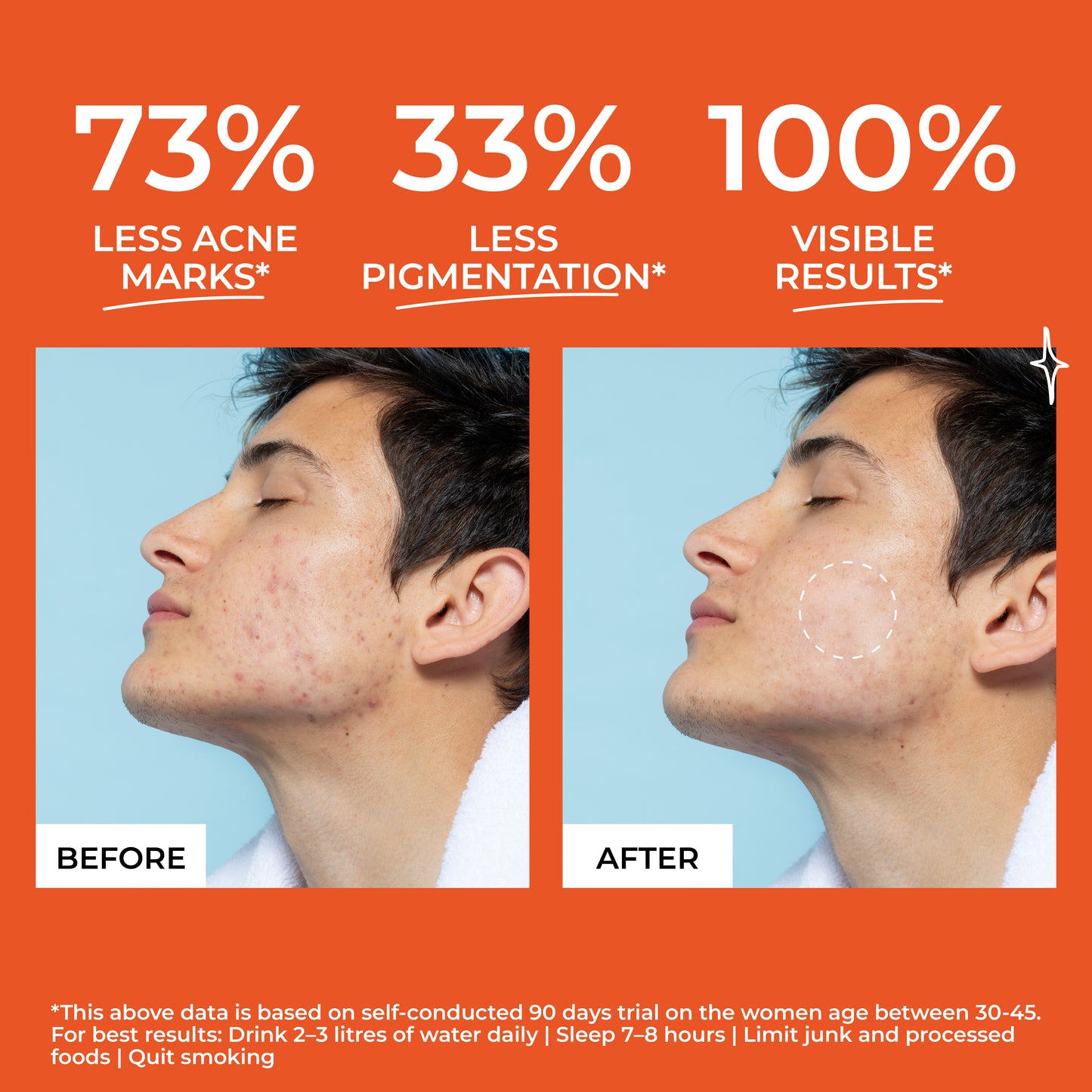 BEYOND SKIN ACNE SKIN SUPPLEMENT (Pack of 3)