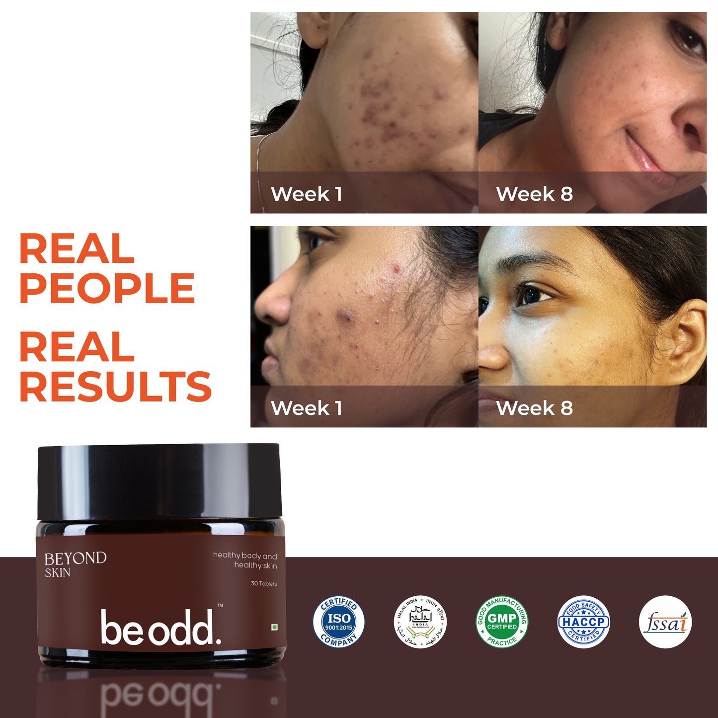 BEYOND SKIN ACNE SKIN SUPPLEMENT (Pack of 3)